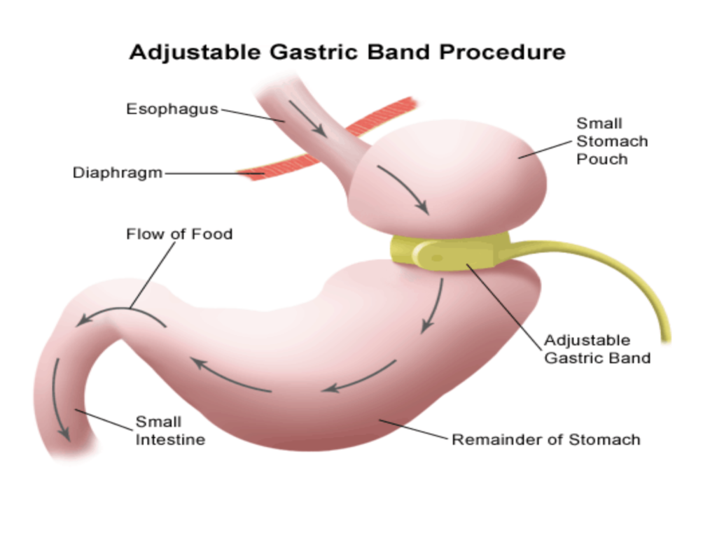 gastric band procedure